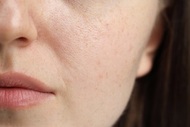 Photo of Macro view of woman with dry skin