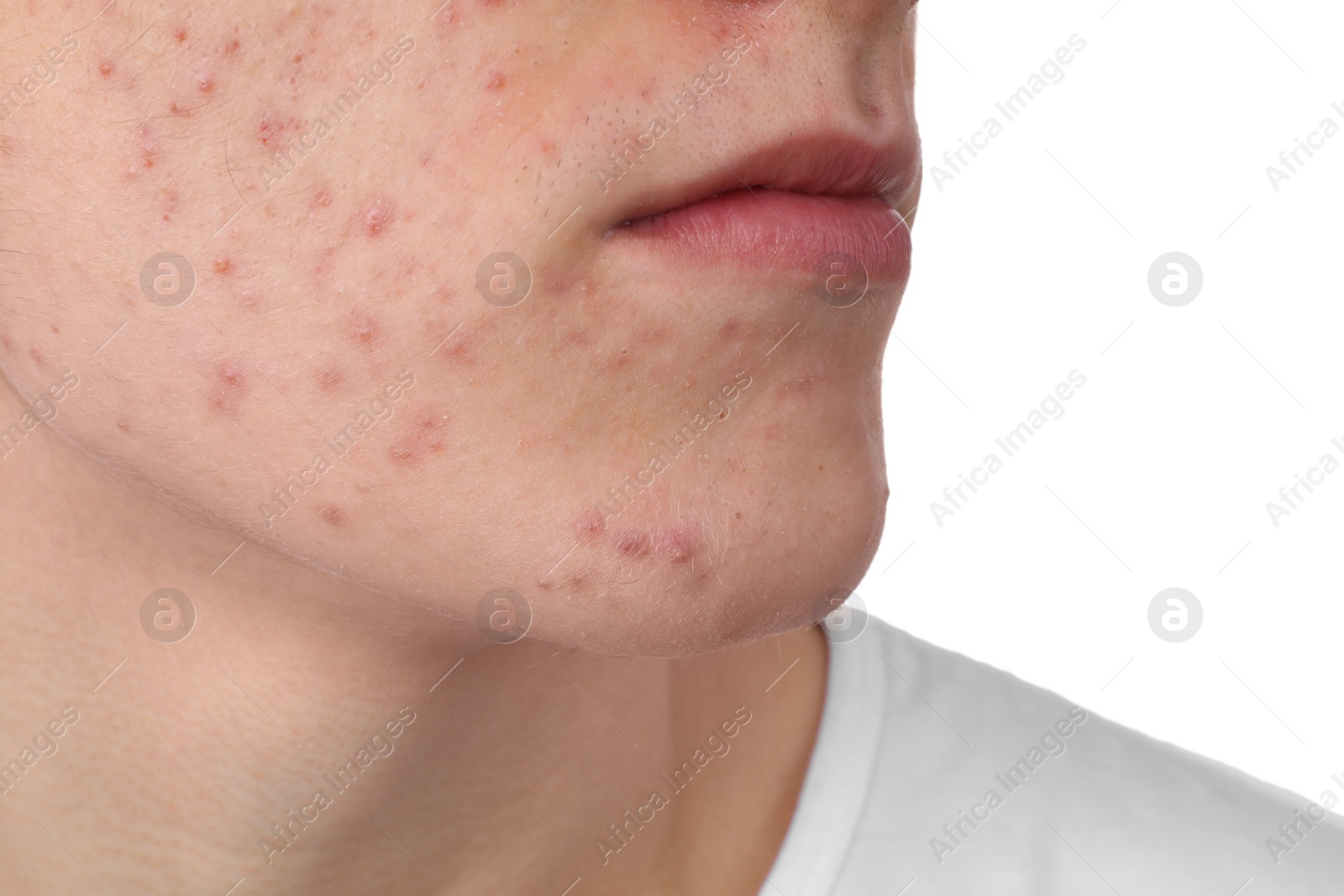 Photo of Young man with acne problem isolated on white, closeup