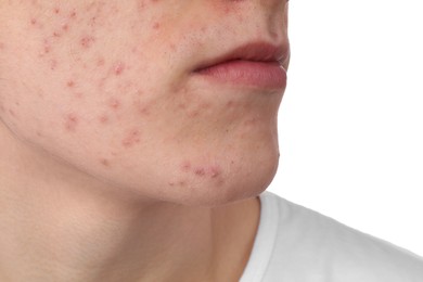 Young man with acne problem isolated on white, closeup