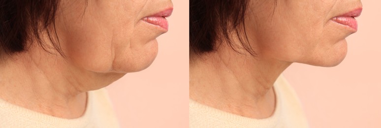 Image of Double chin problem. Collage with photos of mature woman before and after skin tightening treatments on beige background, closeup
