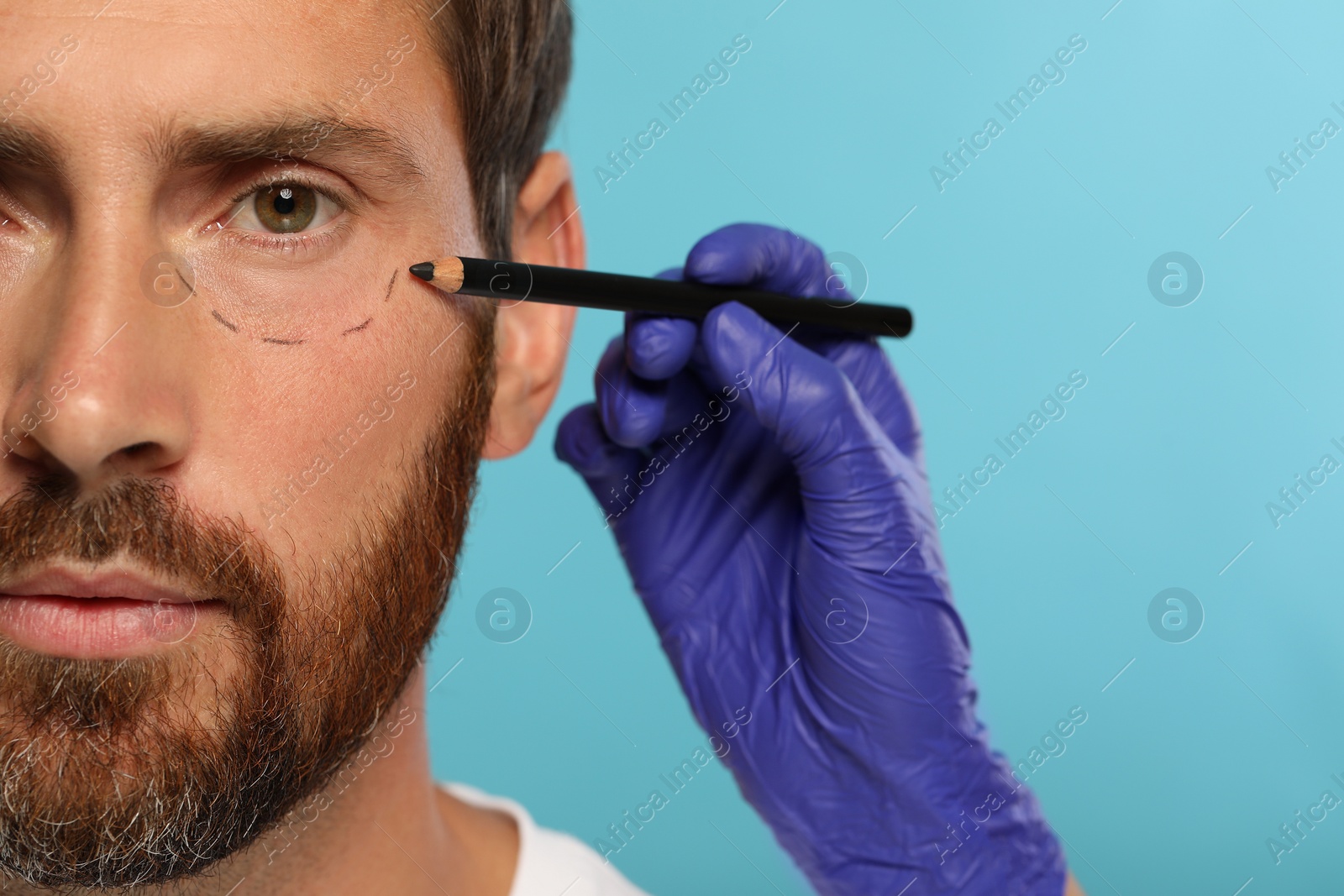 Photo of Doctor with pencil preparing patient for cosmetic surgery operation on light blue background, closeup