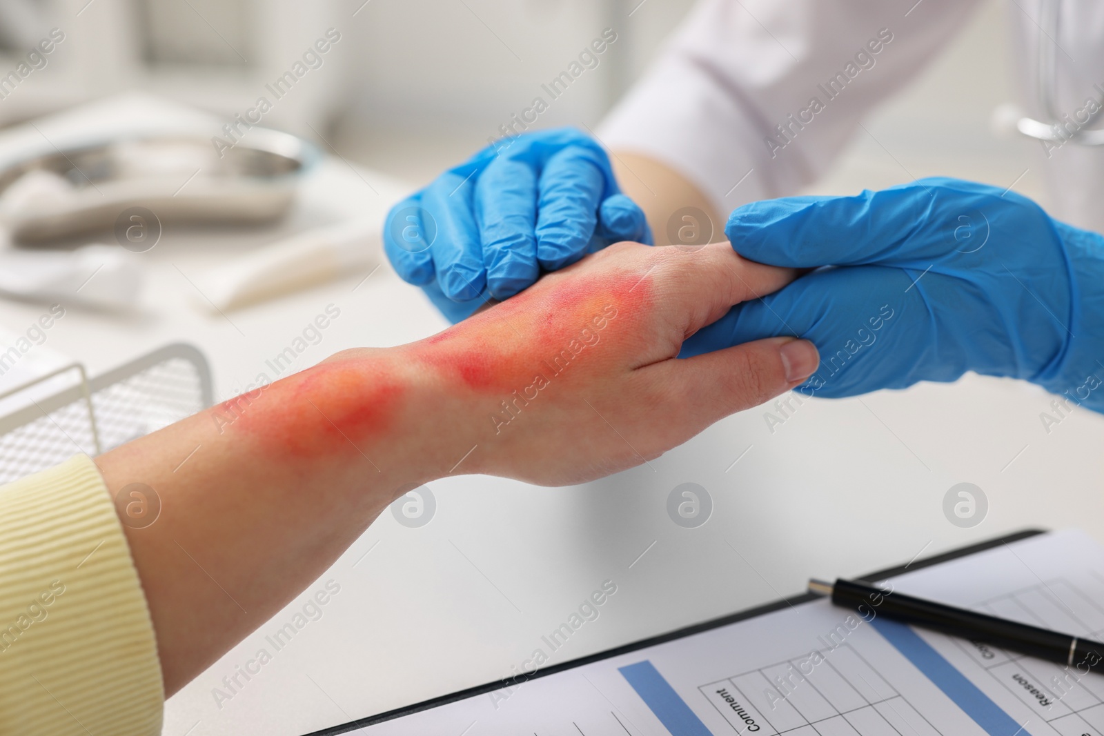 Photo of Doctor examining patient's burned hand in hospital, closeup