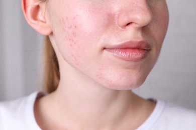 Photo of Woman with acne problem at home, closeup