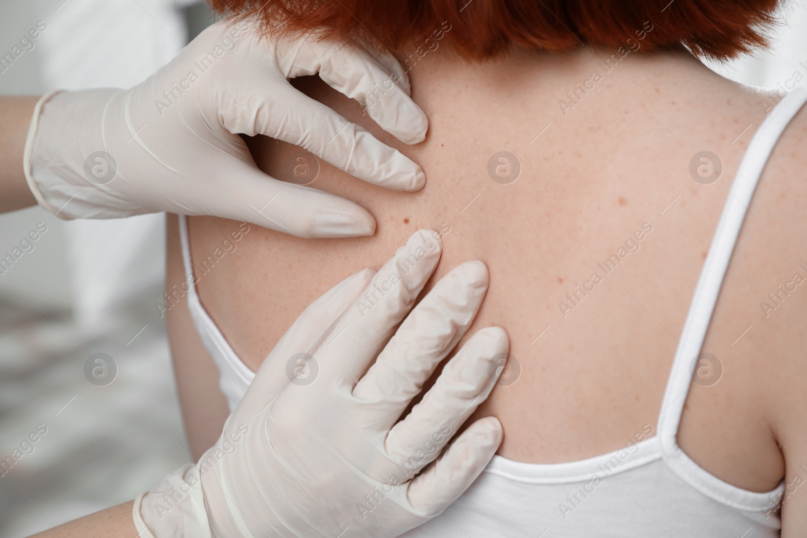 Photo of Dermatologist examining patient's birthmark in clinic, closeup view