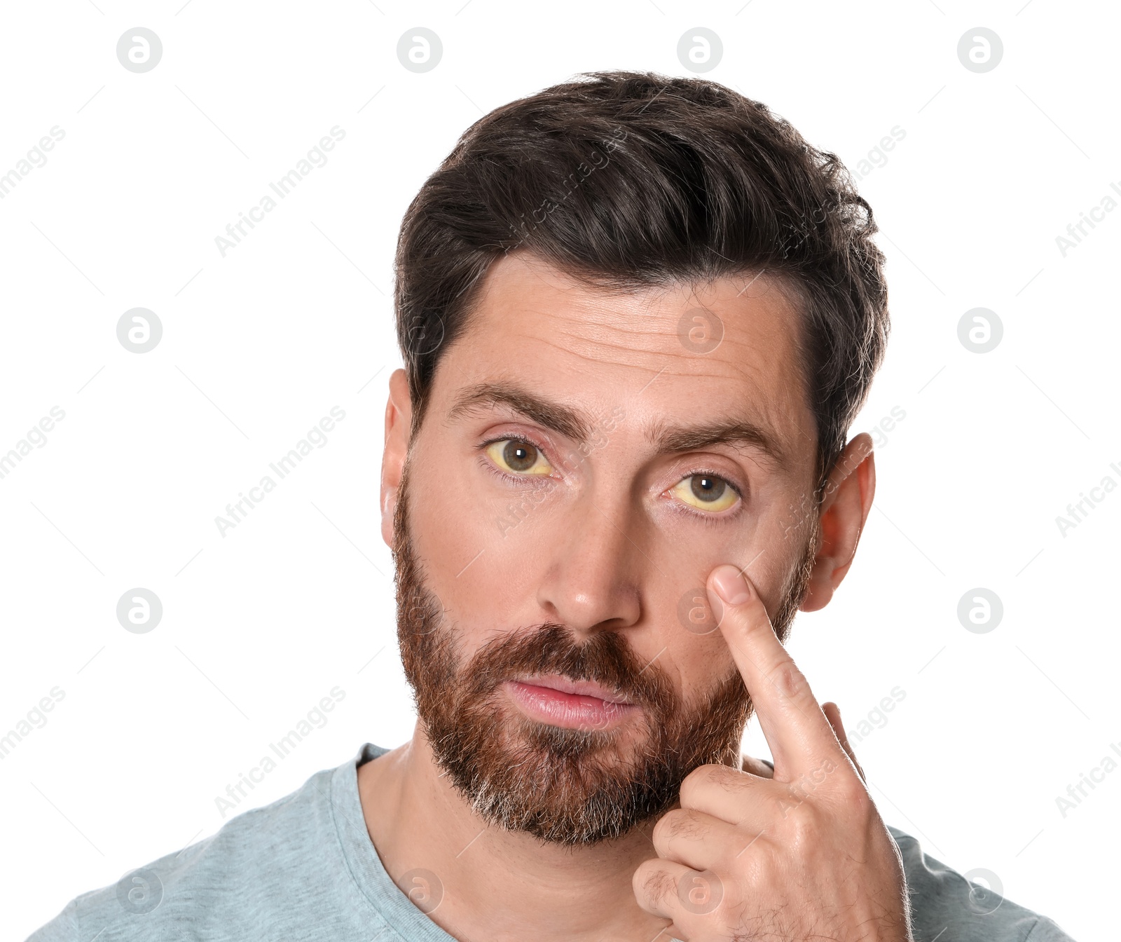 Photo of Man with yellow eyes on white background. Symptom of hepatitis