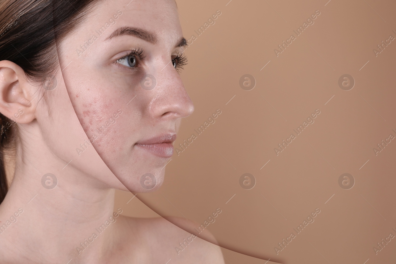 Image of Acne problem, collage. Woman before and after treatment on beige background, space for text