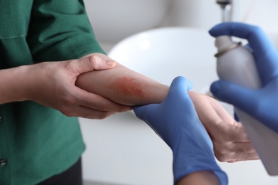 Photo of Applying burn spray onto injured skin, closeup