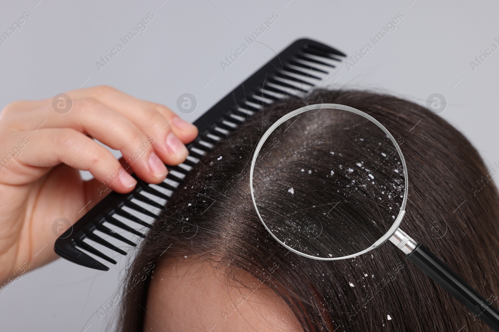Image of Woman suffering from dandruff on light grey background, closeup. View through magnifying glass on hair with flakes