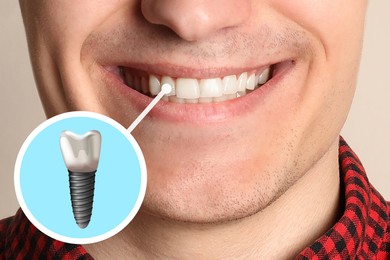 Image of Happy man with perfect teeth smiling on beige background, closeup. Illustration of dental implant