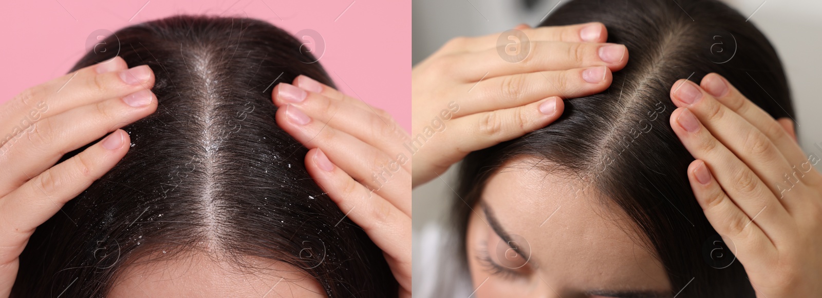 Image of Woman showing hair before and after dandruff treatment on color backgrounds, collage