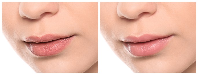 Collage with photos of woman before and after using lip balm on white background, closeup