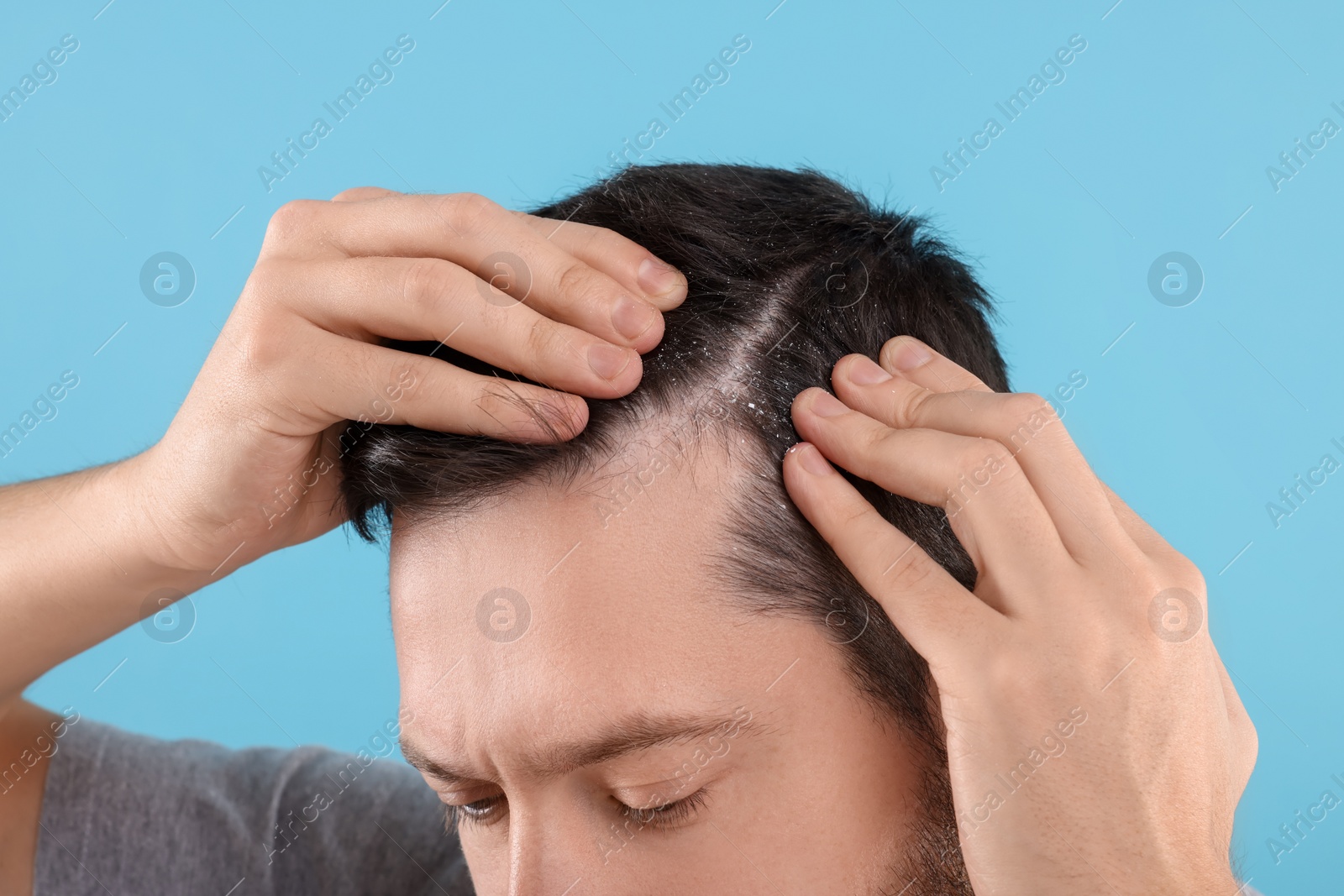 Photo of Man with dandruff in his dark hair on light blue background, closeup