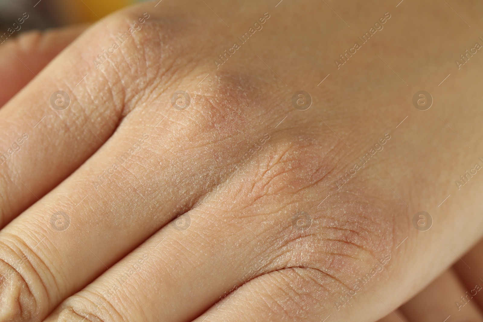 Photo of Closeup view of person with dry skin on hand