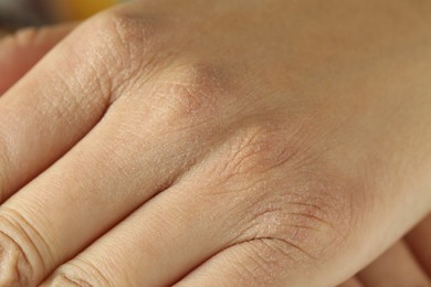 Closeup view of person with dry skin on hand