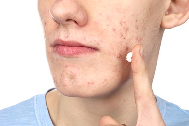 Young man with acne problem applying cosmetic product onto his skin on white background, closeup