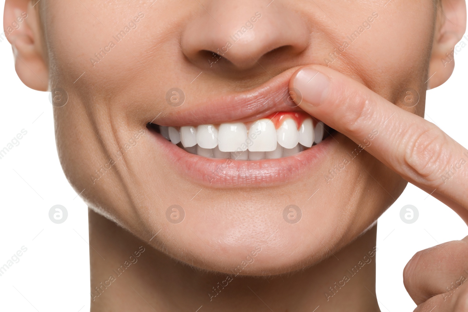 Image of Woman showing inflamed gum on white background, closeup