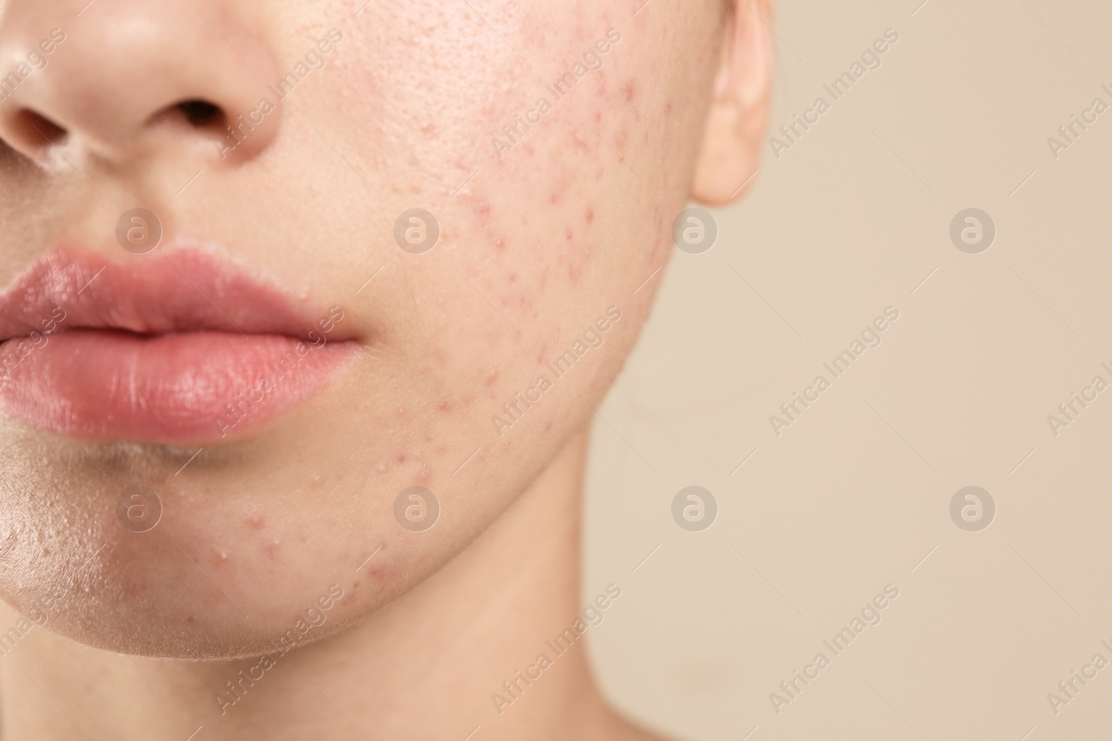 Photo of Teenage girl with acne problem on beige background, closeup