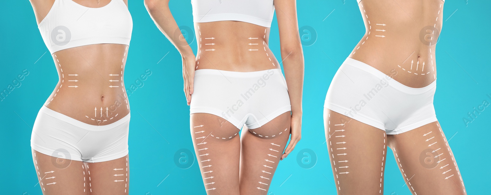 Image of Photos of young woman with marks on body against blue background, collage. Cosmetic surgery concept