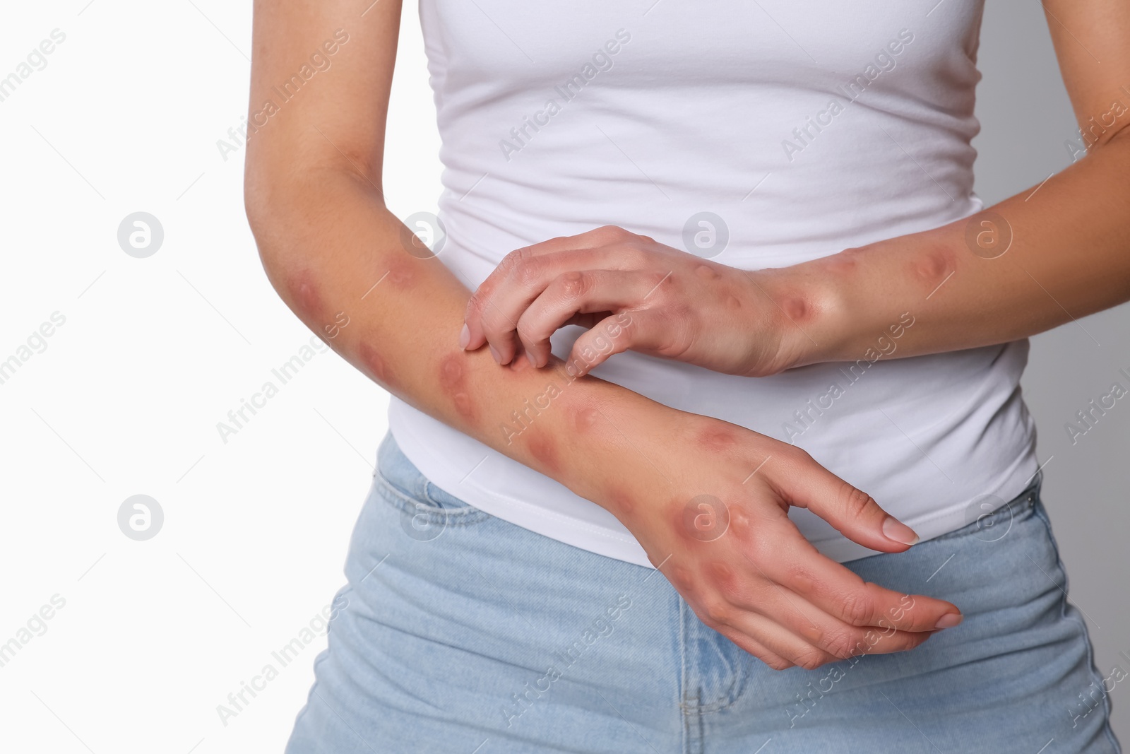 Photo of Woman with rash suffering from monkeypox virus on white background, closeup