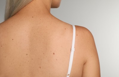Photo of Closeup of woman`s body with birthmarks on light grey background, back view