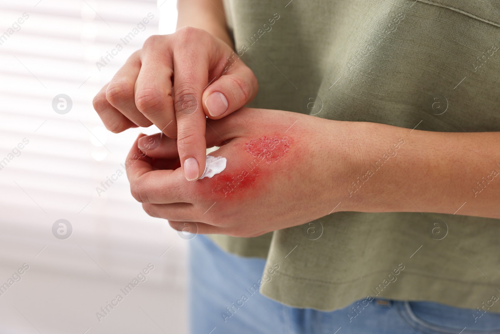 Photo of Woman applying healing cream onto burned hand indoors, closeup