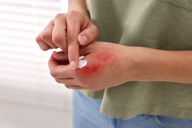 Woman applying healing cream onto burned hand indoors, closeup