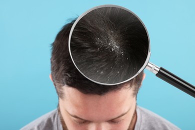 Man suffering from dandruff on light blue background, closeup. View through magnifying glass on hair with flakes