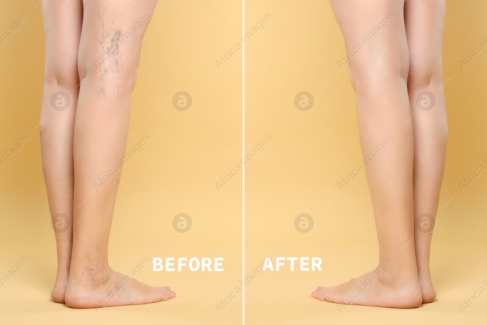 Image of Before and after varicose veins treatment. Collage with photos of woman showing legs on yellow background, closeup