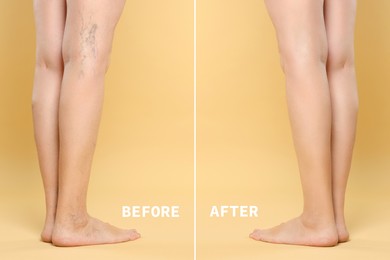 Image of Before and after varicose veins treatment. Collage with photos of woman showing legs on yellow background, closeup