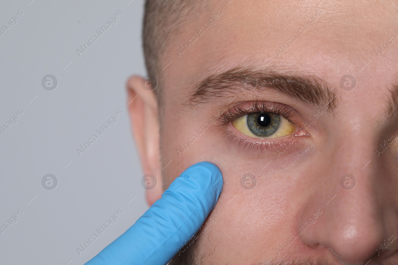 Photo of Doctor checking yellow eyes of patient on light grey background, closeup and space for text. Hepatitis symptom