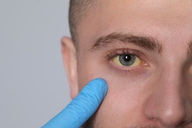 Doctor checking yellow eyes of patient on light grey background, closeup and space for text. Hepatitis symptom