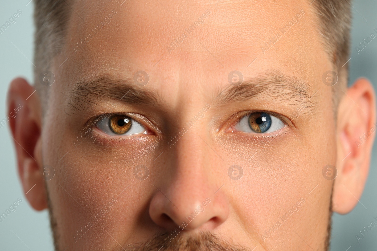 Image of Man with beautiful eyes of different colors, closeup. Heterochromia iridis