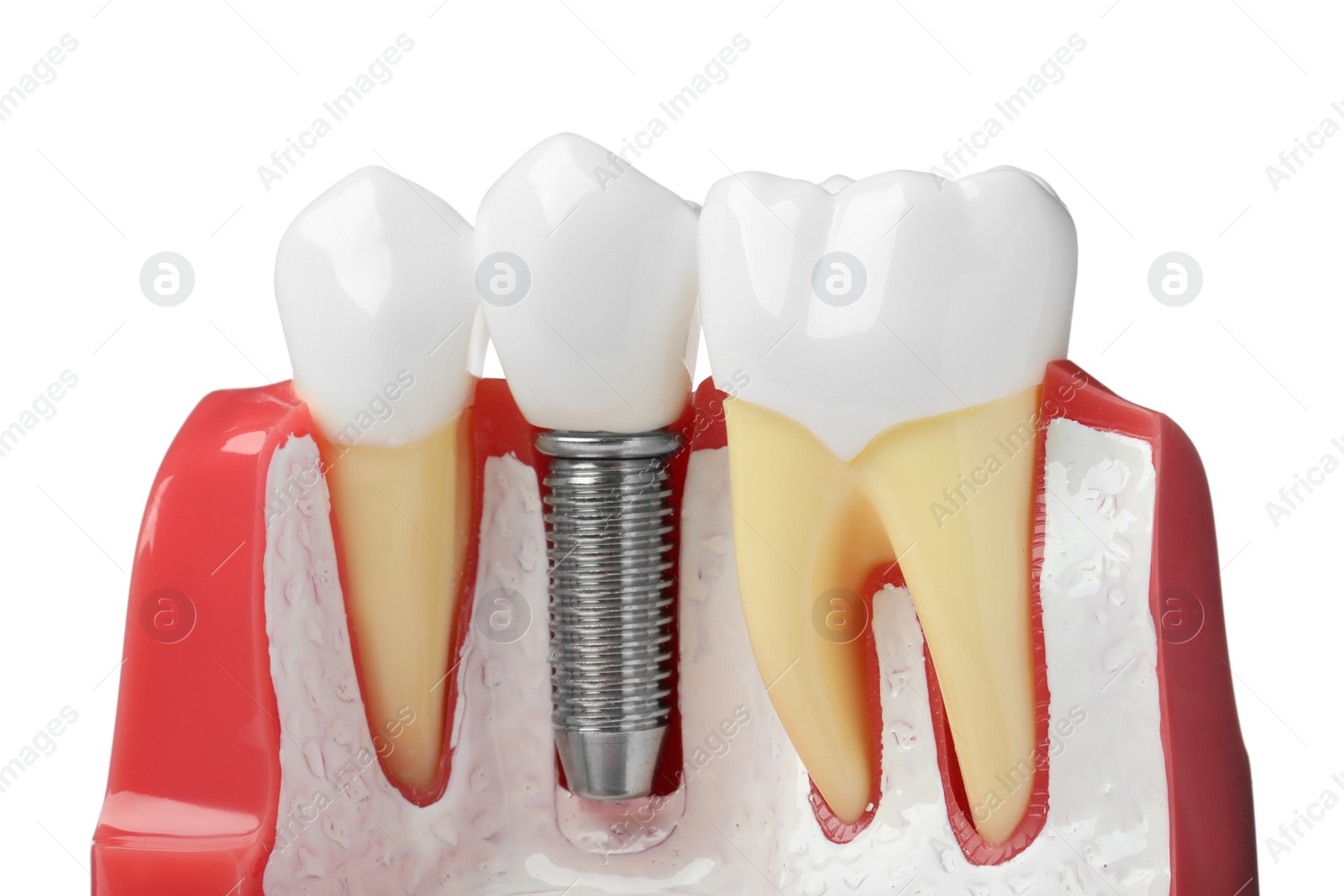 Photo of Educational model of gum with dental implant between teeth on white background