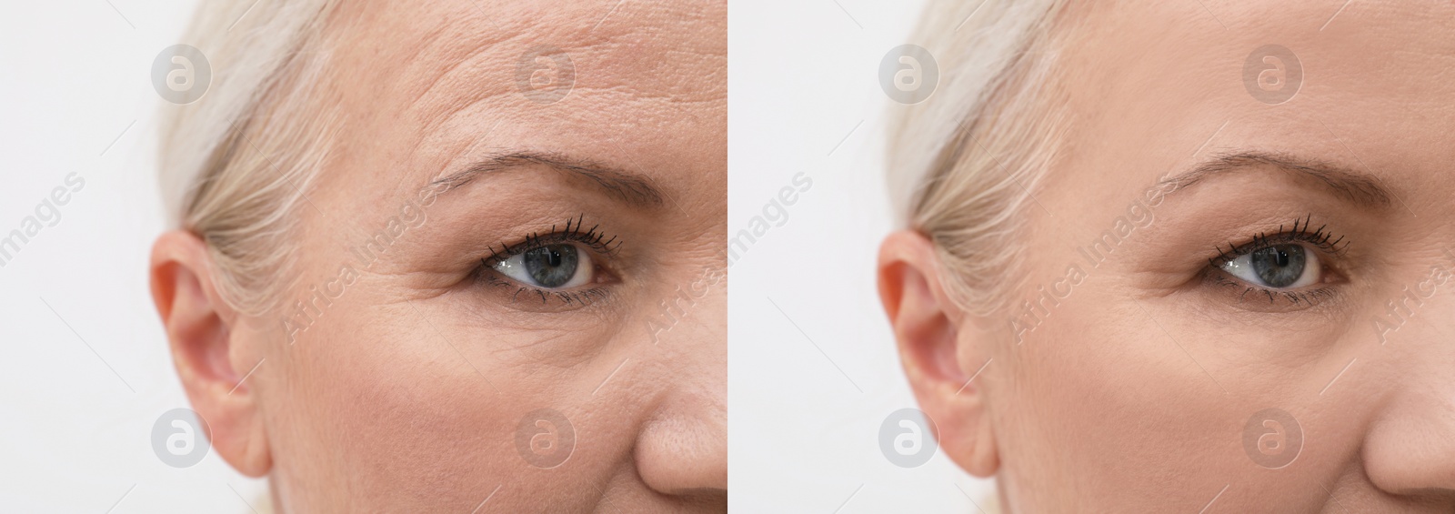 Image of Woman looking better due to cosmetic procedures. Collage with photos on white background before and after rejuvenation, closeup
