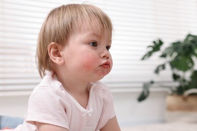 Photo of Portrait of little girl with diathesis symptom on cheeks indoors, closeup. Space for text