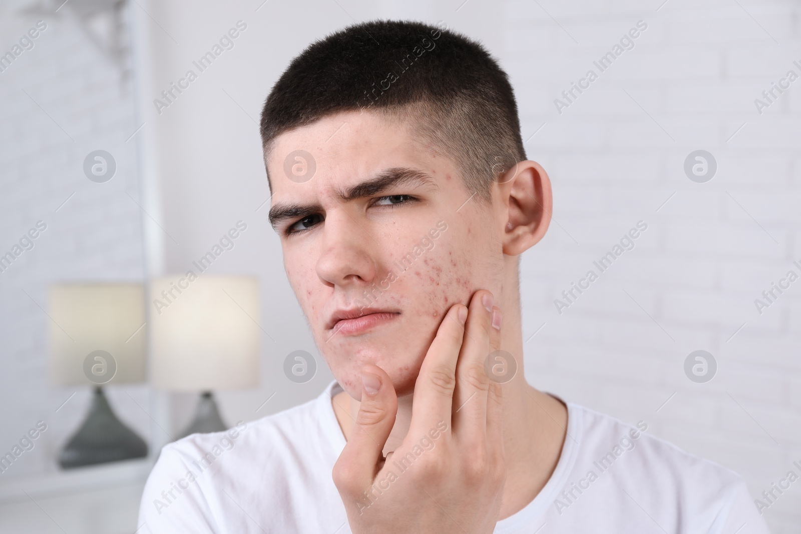 Photo of Young man touching pimple on his face indoors. Acne problem