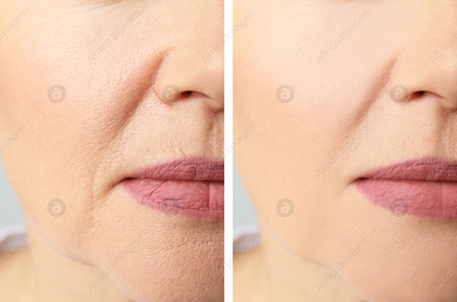 Image of Collage with photos of mature woman before and after biorevitalization procedure, closeup