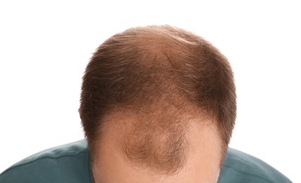 Photo of Man with hair loss problem on white background, closeup. Trichology treatment