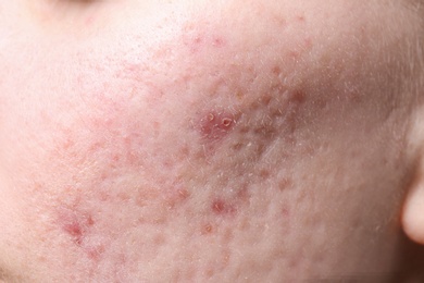 Photo of Young woman with acne on her face, closeup