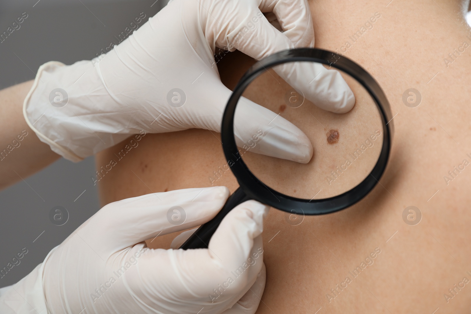 Photo of Dermatologist examining patient's birthmark with magnifying glass in clinic, closeup view