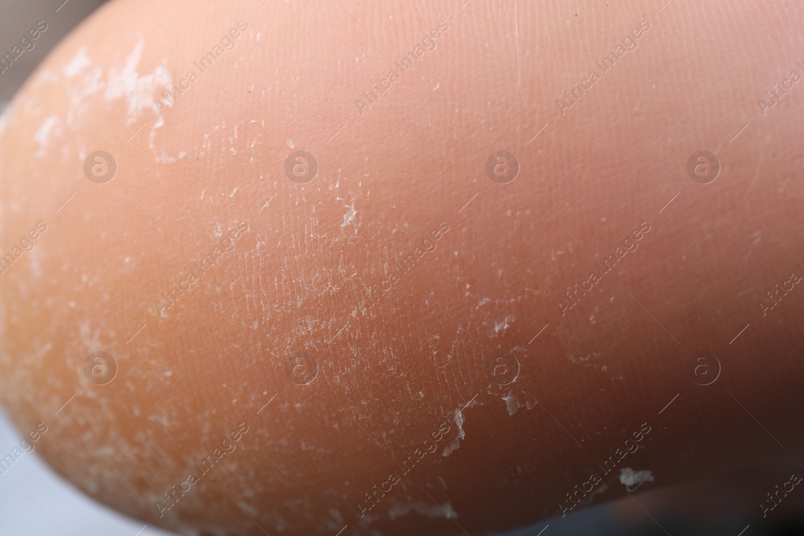 Photo of Woman with dry skin on foot, closeup