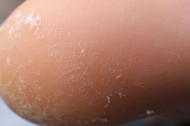 Photo of Woman with dry skin on foot, closeup