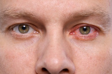 Image of Man with red eye suffering from conjunctivitis, closeup