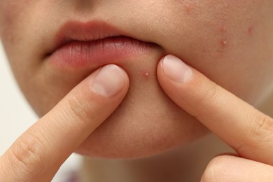 Photo of Young woman touching pimple on her face against white background, closeup. Acne problem