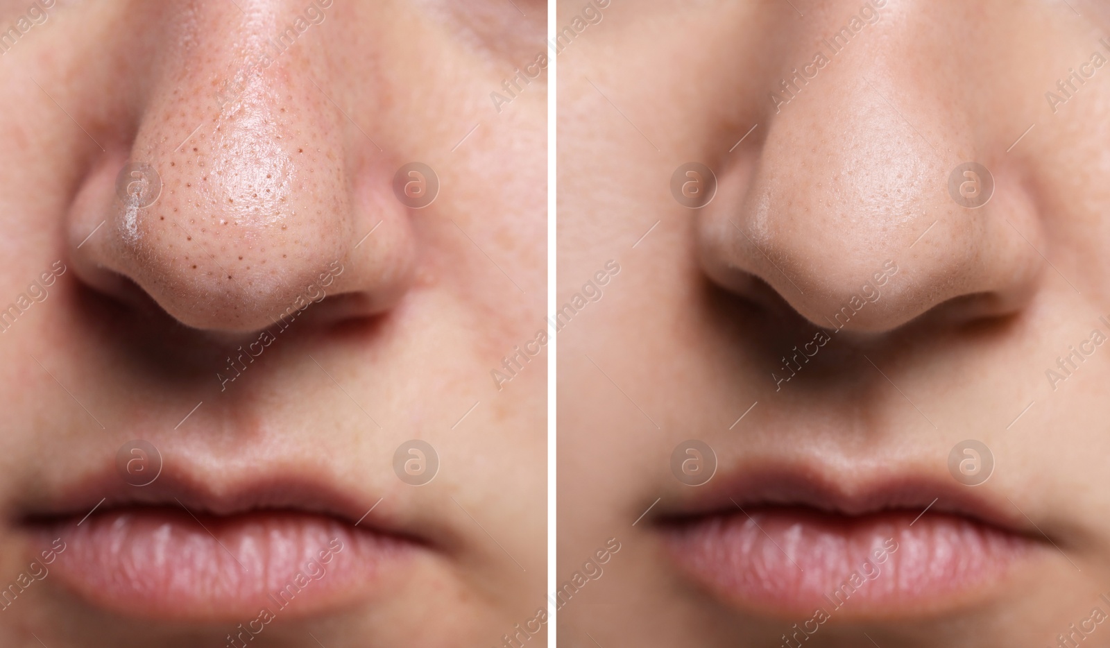 Image of Blackhead treatment, before and after. Collage with photos of woman, closeup view