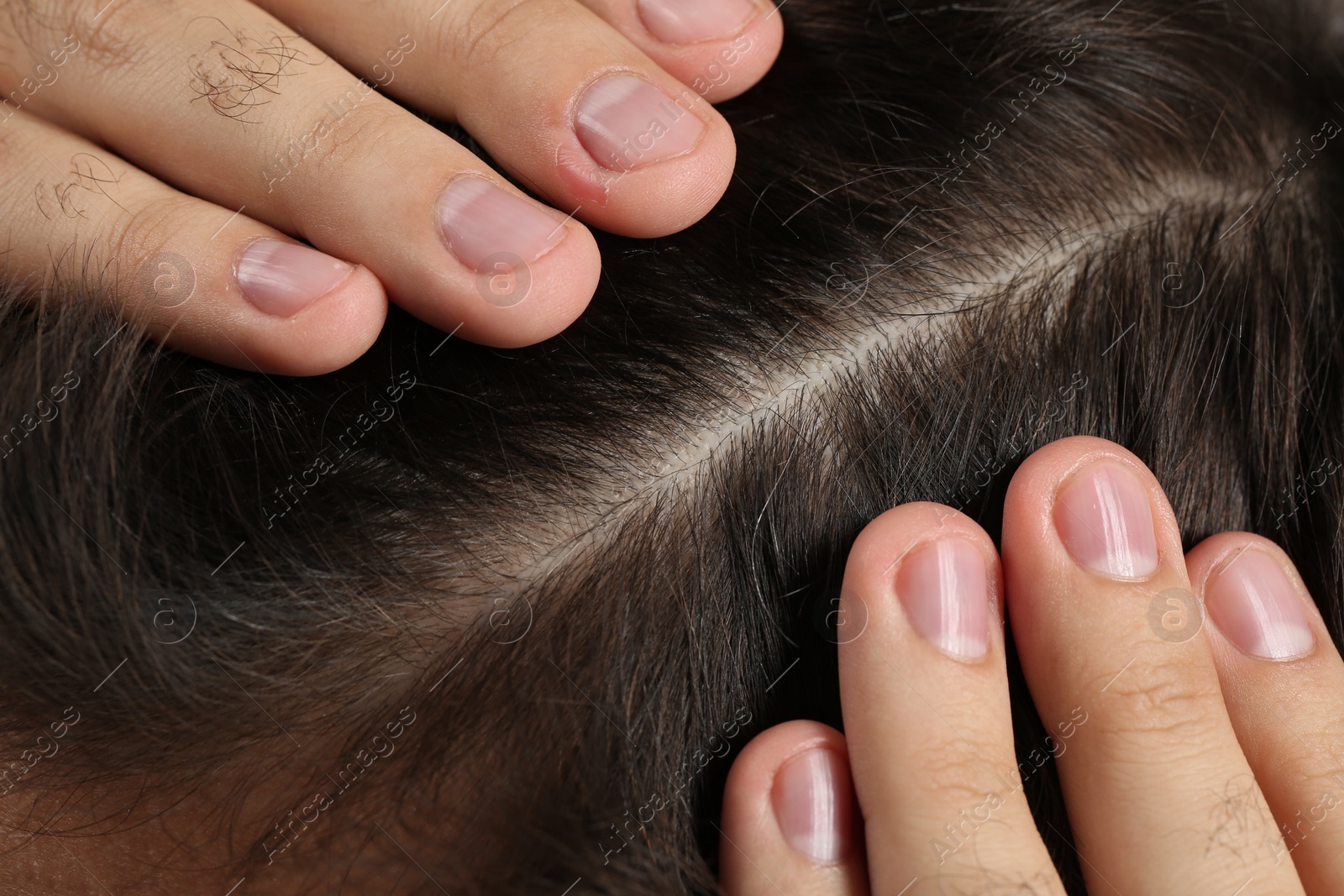 Photo of Man examining his head, closeup. Dandruff problem