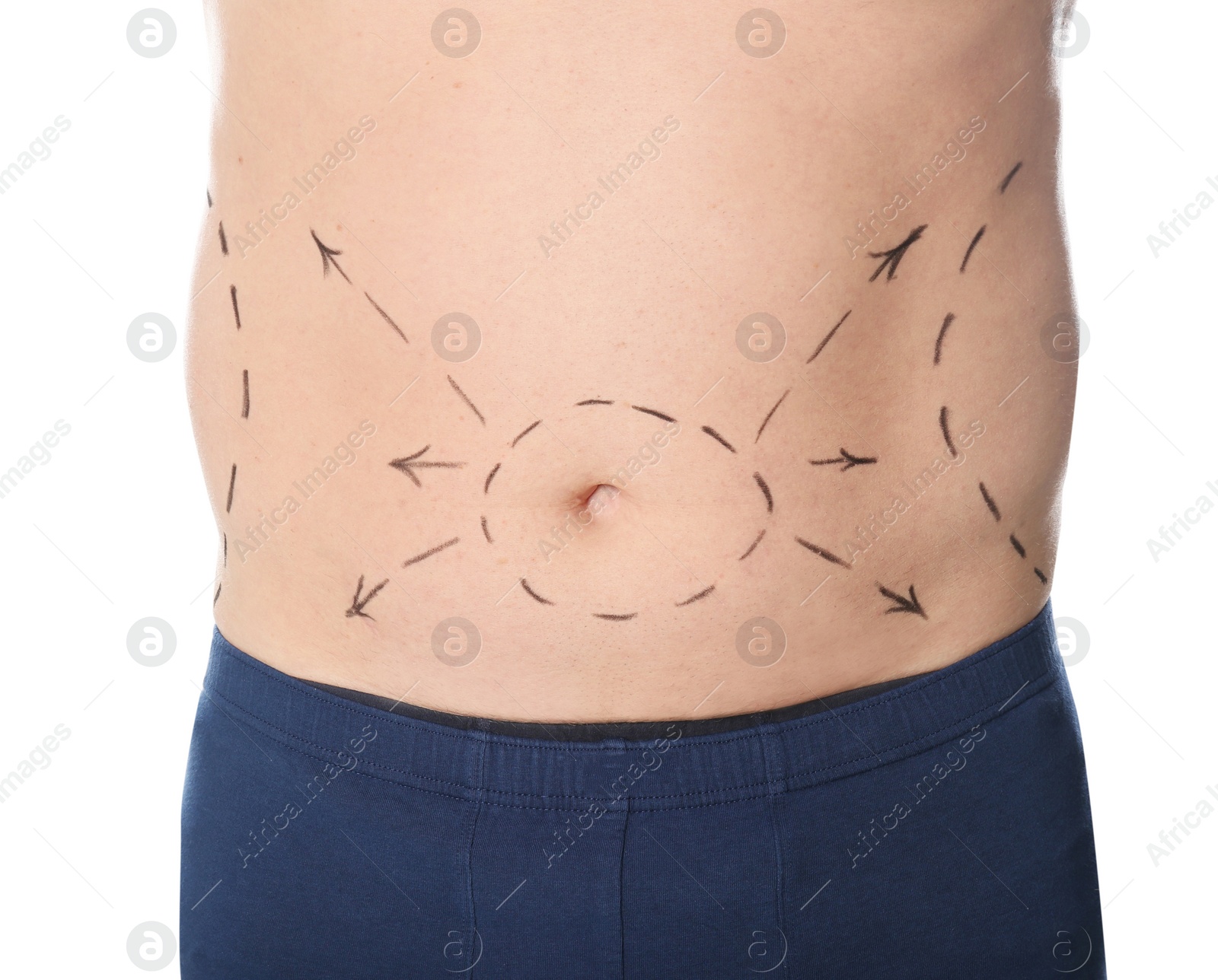 Photo of Man with marks on belly for cosmetic surgery operation against white background, closeup