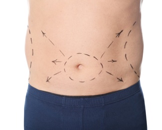 Man with marks on belly for cosmetic surgery operation against white background, closeup