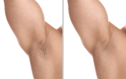 Image of Collage of man showing armpit before and after epilation on white background, closeup 