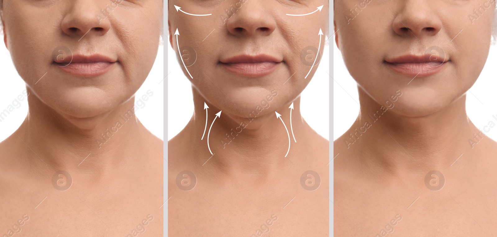 Image of Mature woman before and after plastic surgery operation on white background, closeup. Double chin problem 